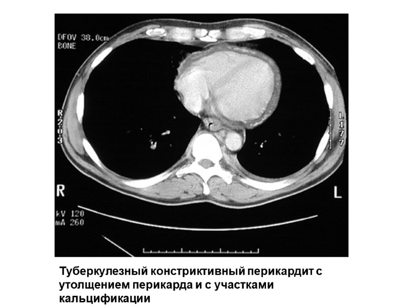 Туберкулезный констриктивный перикардит с утолщением перикарда и с участками  кальцификации